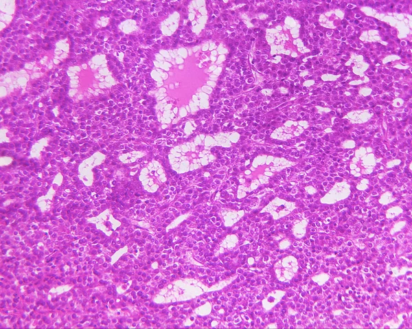Hepatocellular carcinoma of a human