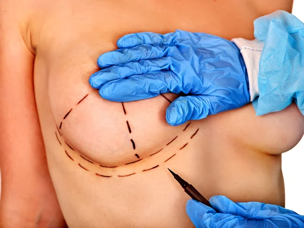 Breast cancer surgery. Doctor makes dotted line on female body.