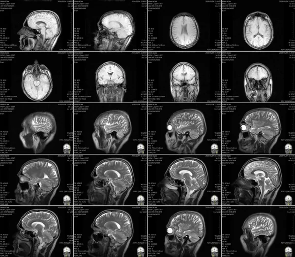 Magnetic resonance imaging of the brain with no visible abnormalities.