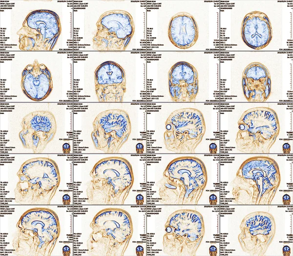 Magnetic resonance imaging of the brain