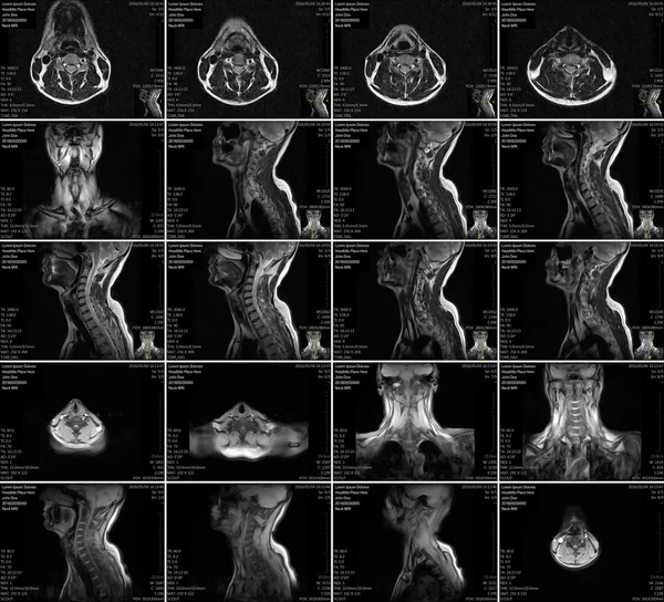 Magnetic resonance imaging of the cervical spine.