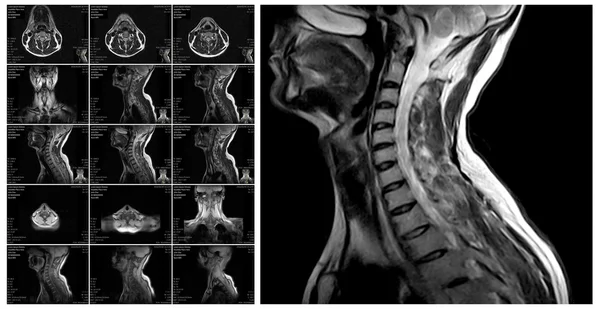 Magnetic resonance imaging of the cervical spine.