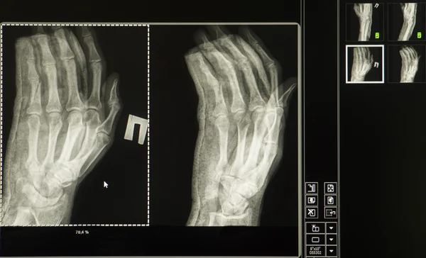 X-ray  of a broken hand