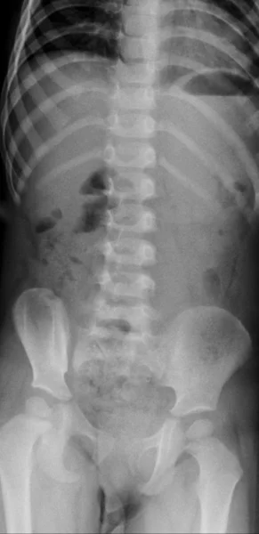 X-Ray Image Of Human Chest for a medical diagnosis