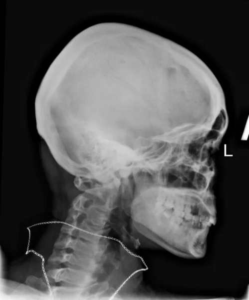 X-Ray Image Of Human Head