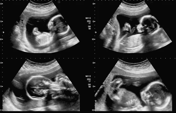 Medical images collage of ultrasound during woman pregnancy show