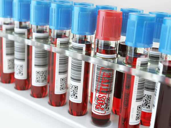 Blood sample positive and many others blood test tubes in a rack