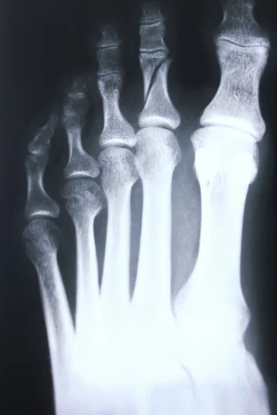 Foot and toes injury x-ray scan orthopedics and Traumatology radiology test results photo.