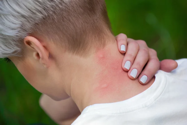 Girl with blond hair, sitting with his back turned and scratching bitten, red, swollen neck skin from mosquito bites in the summer in the forest. Close-up up of visible insect bites. Irritated skin