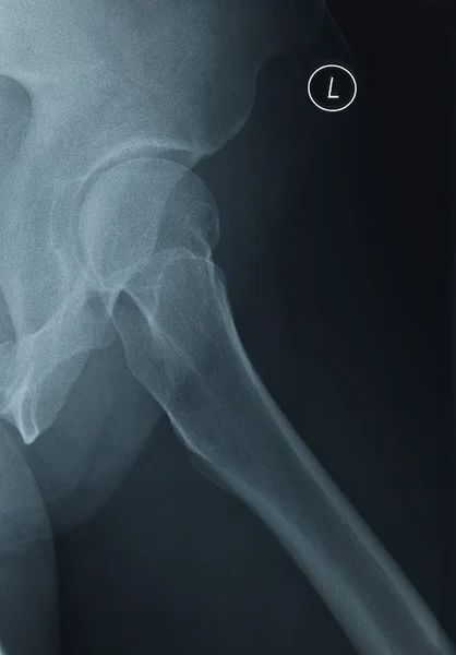 Female Left Hip X-Ray