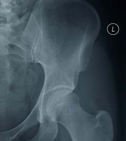 Female Left Hip X-Ray