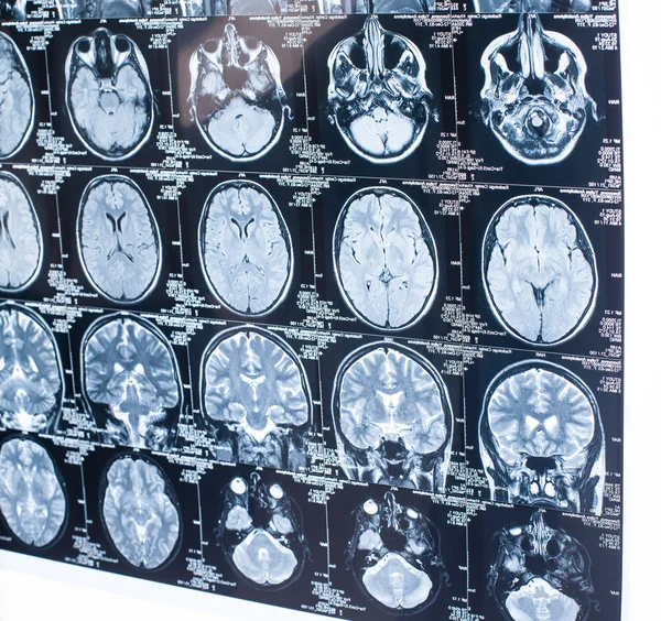 MRI diagnostics of human brain