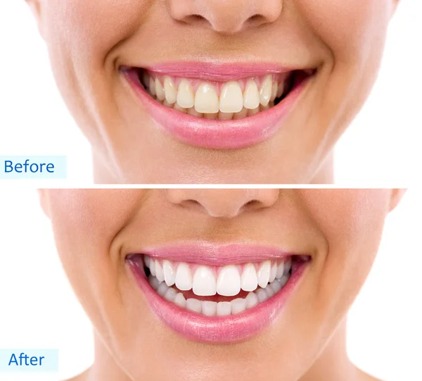 Whitening - bleaching treatment ,woman teeth and smile, before after