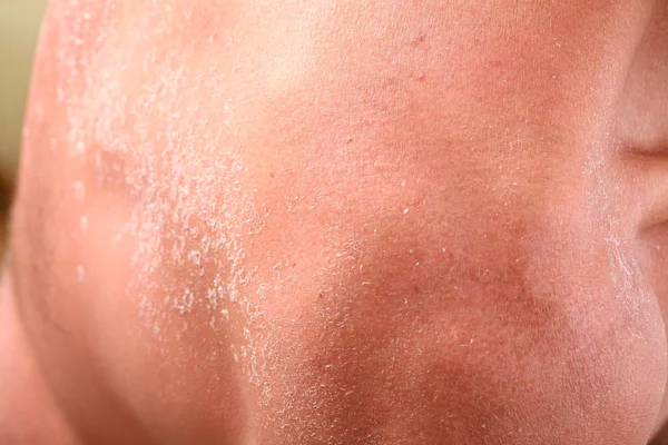 Skin peeling after sunburn