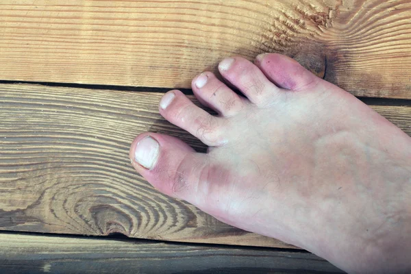 Foot disease, skin infections