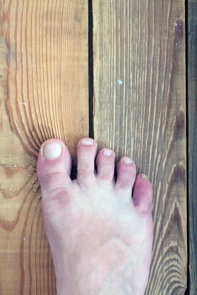 Foot disease, skin infections