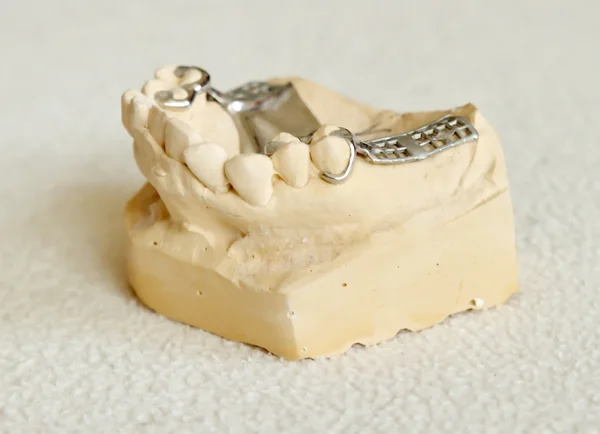 Metal framework for partial denture