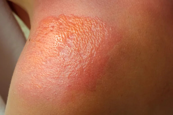 Close up detail of a very bad sunburn