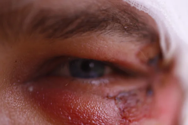 Close up of swollen eye after an accident with scars
