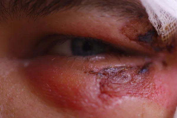 Close up of swollen eye after an accident with scars