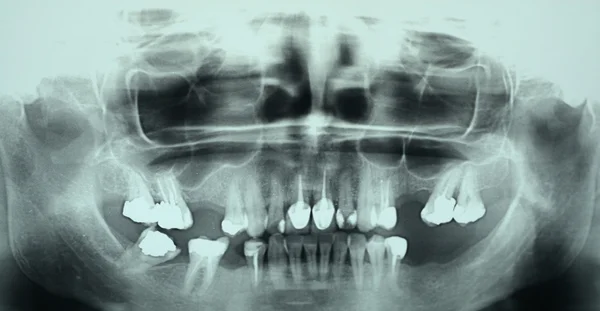 X-ray dental of tooth