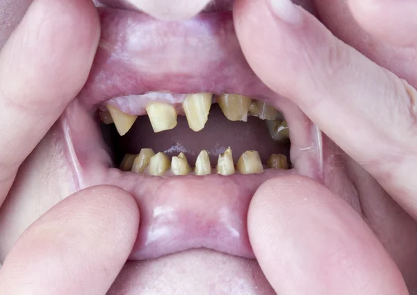 Teeth  are prepared for dentures  installation