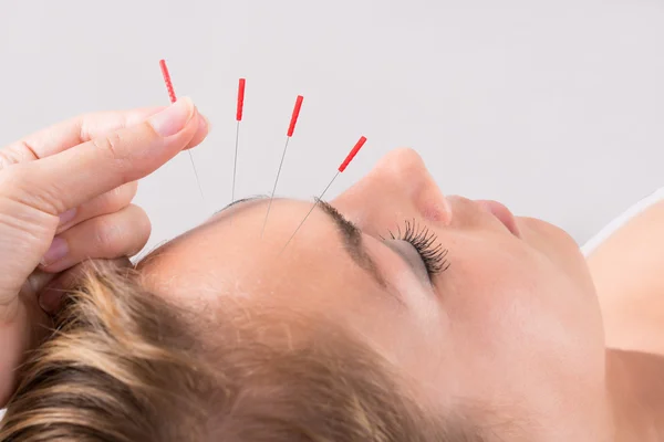 Hand Performing Acupuncture Therapy On Head