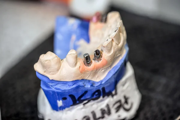 Dental implants, denture concept
