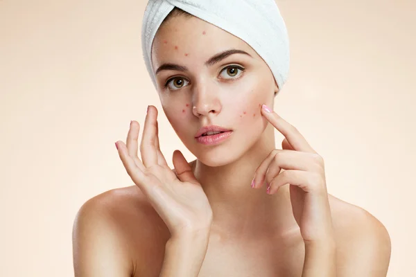 Scowling girl show her acne with a towel on her head. Woman skin care concept