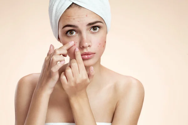 Acne spot pimple spot skincare beauty care girl pressing on skin problem face. Woman with skin blemish isolated, beige background. Beautiful young Caucasian female model