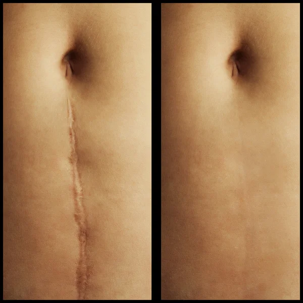 Removal of scars on the skin of the abdomen