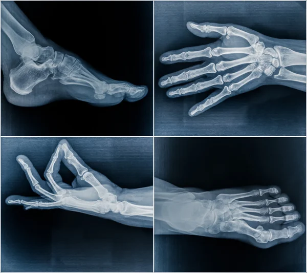 50 year Old Woman's X-Ray Scans from Hands and Feet