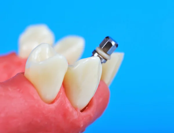 Dental titanium implant