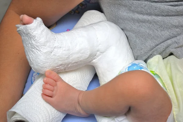 Baby Foot In Bandage And Cast