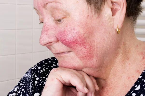 Elderly woman with rosacea, facial skin disorder