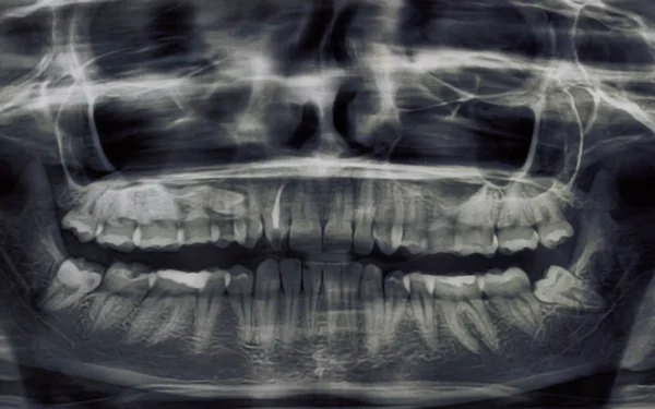 Panoramic dental X-Ray of teeth