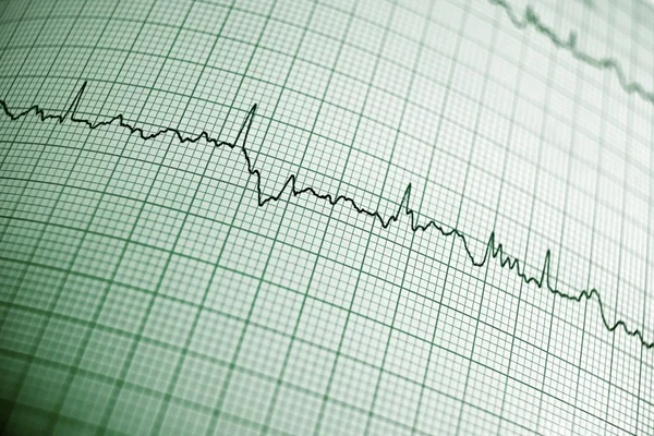 Electrocardiogram