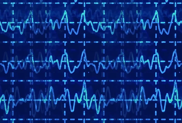 Brain wave on electroencephalogram EEG for epilepsy, illustration