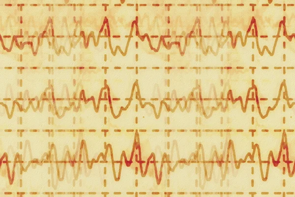 Brain wave on electroencephalogram EEG for epilepsy, illustration grunge background