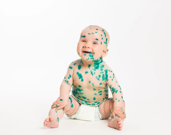 Chicken pox ailing infant on white background