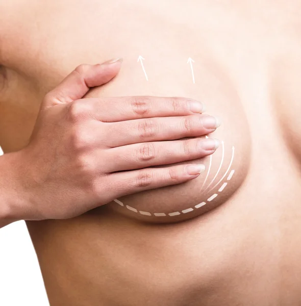 Breast  correction. Plastic surgery