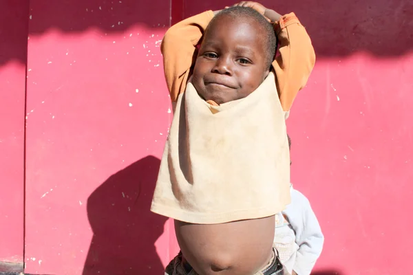 The Swollen belly of an African child