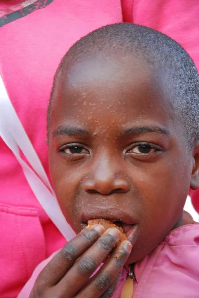 The skin of a child sick with AIDS