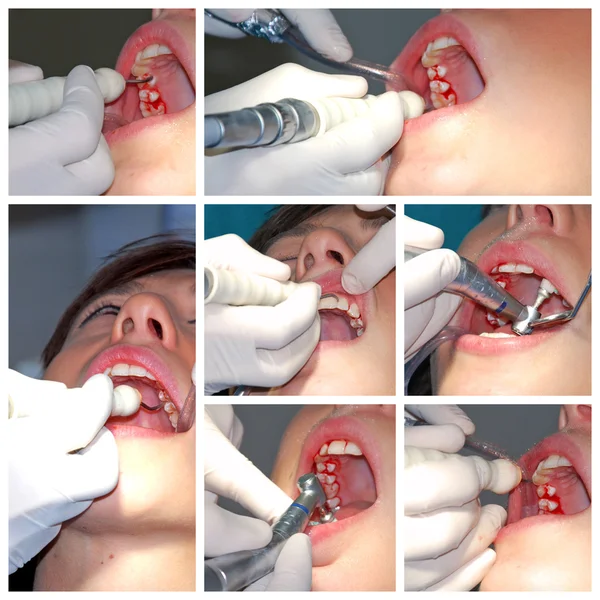 Prevention and treatment of the teeth