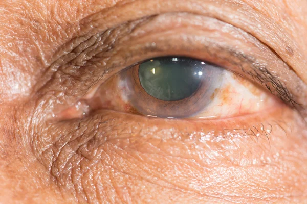 Senile cataract at eye test