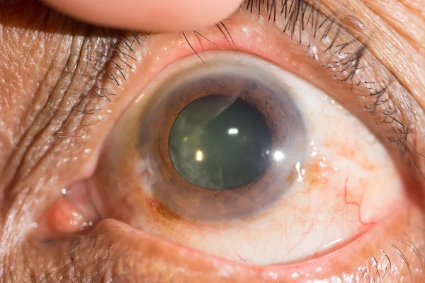 Senile cataract at eye test