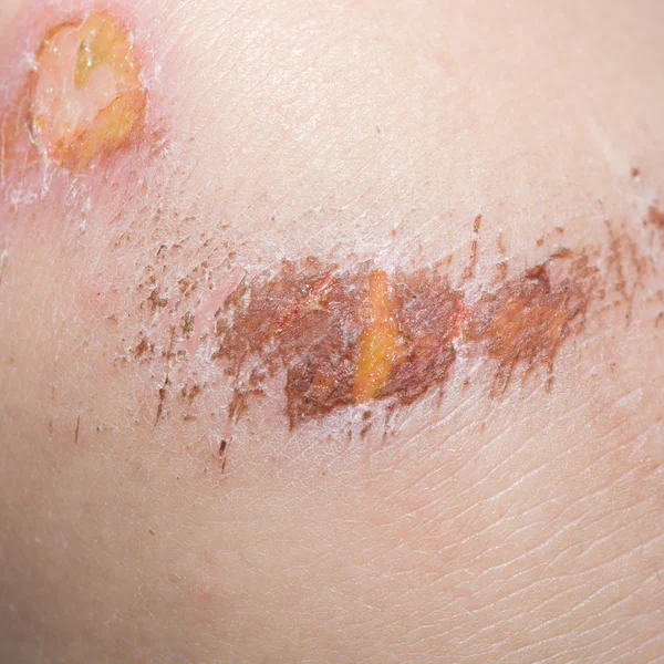 Skin wound