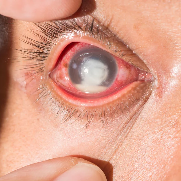 Eye exam, fungal corneal ulcer