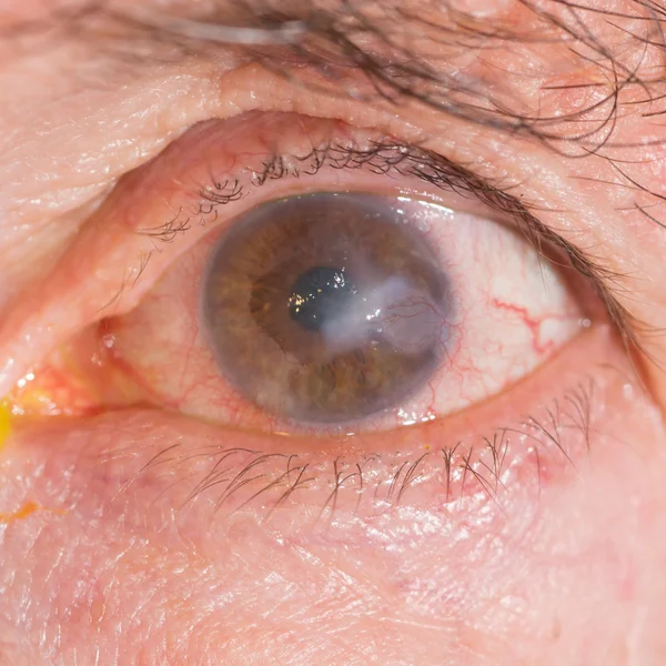 Eye exam, interstitial keratitis