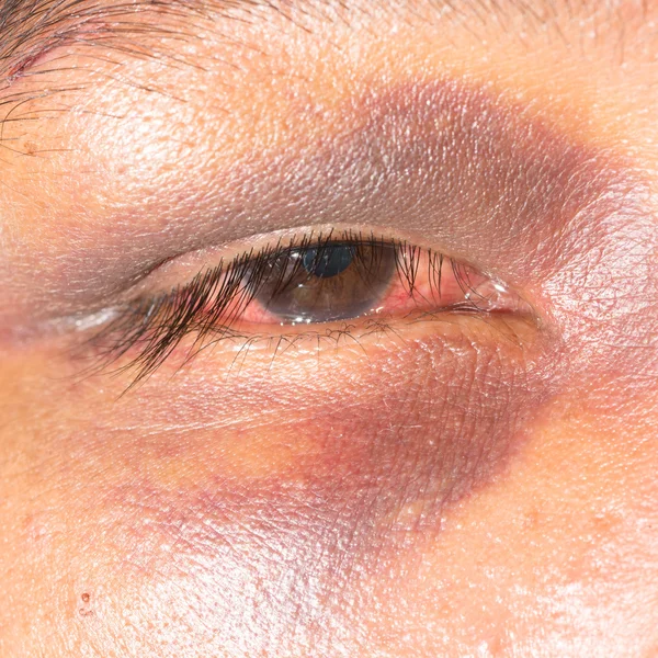 Periorbital ecchymosis at eye exam